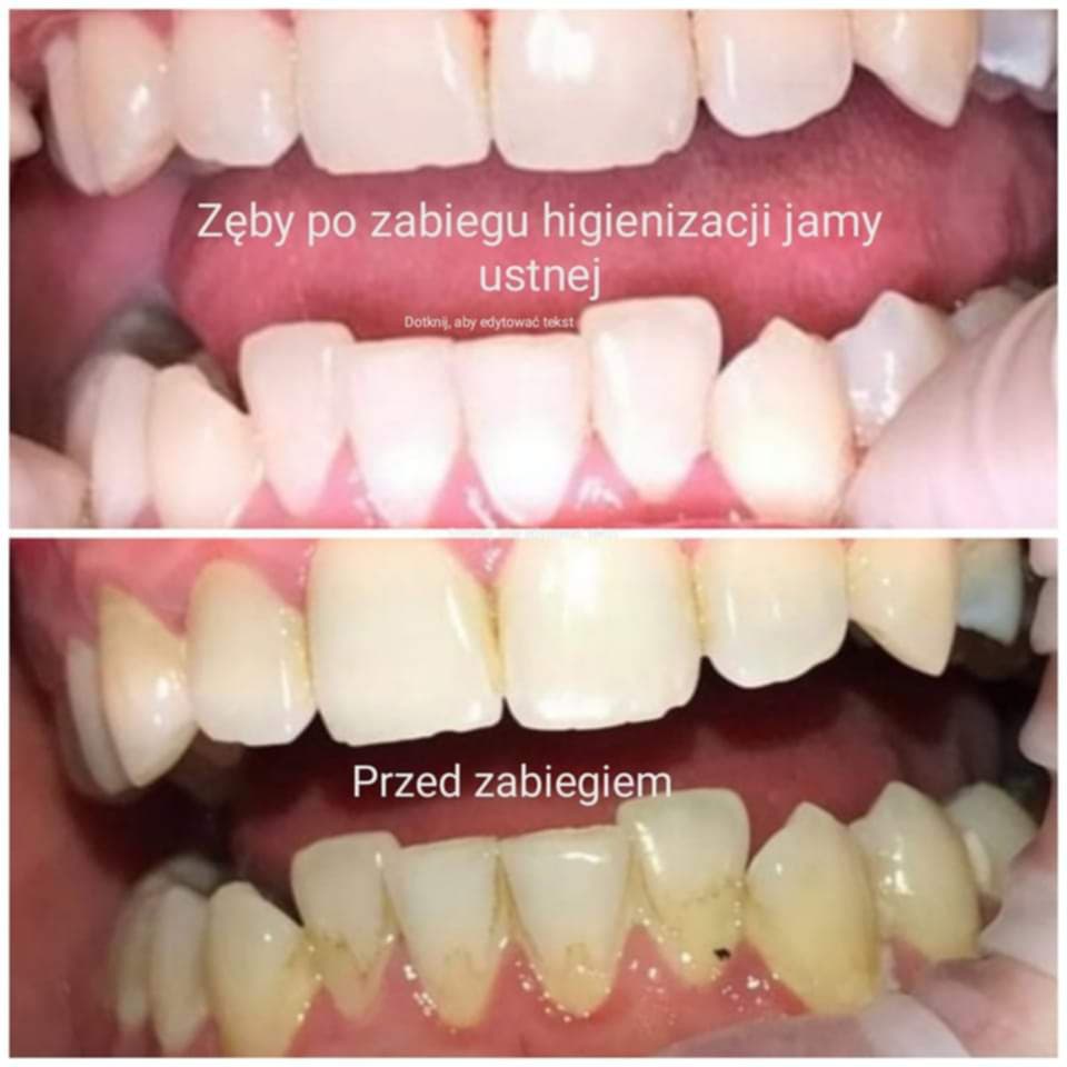 Rozświetlony uśmiech po serii zabiegów profilaktycznych