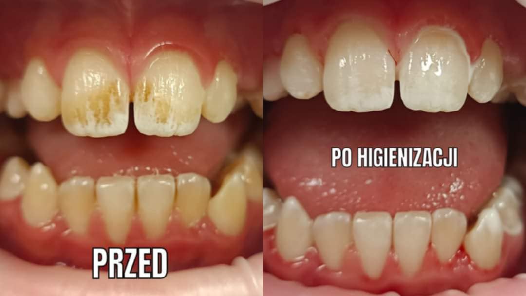 Przemiana estetyki zębów po zabiegach higienistycznych