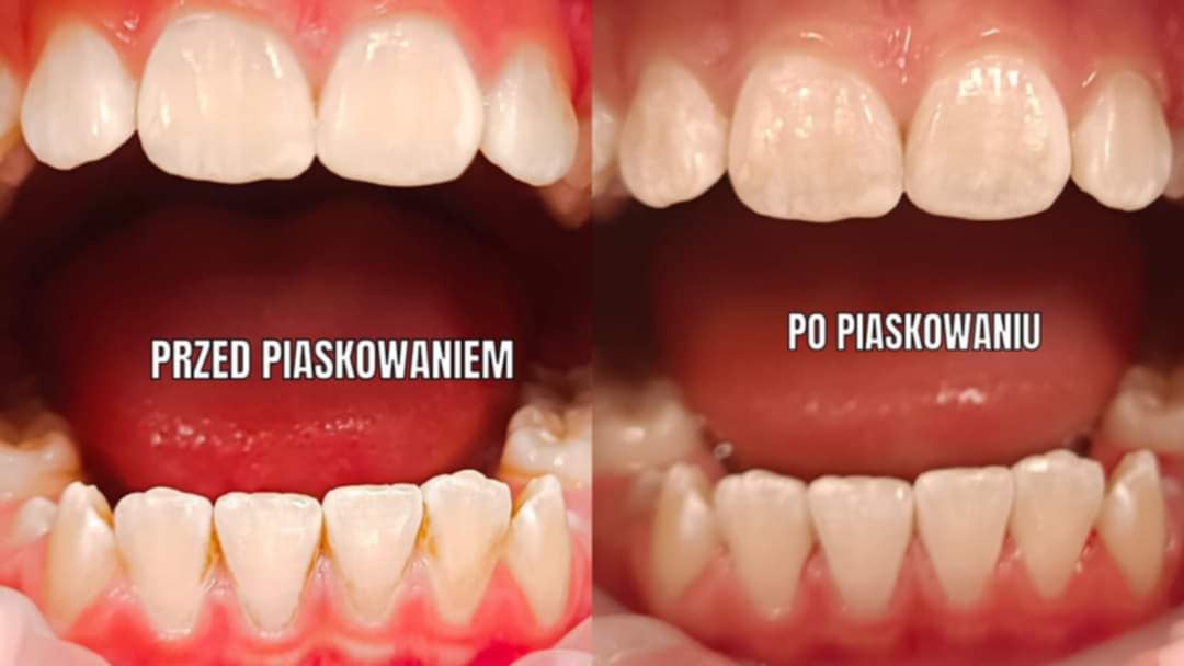 Kolejna metamorfoza uśmiechu osiągnięta dzięki zabiegom AurisDent